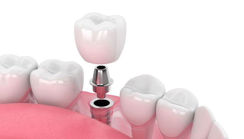 C1：軽度のむし歯