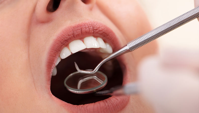 C1：軽度のむし歯